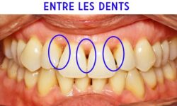 eliminez-les-dents-de-triangle-noir-avec-ce-remede-maison-efficace
