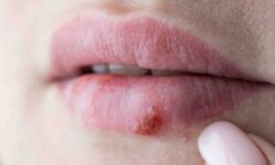 eruption-cutanee-symptomes-et-solutions-pour-soulager