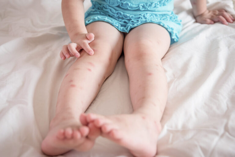 piqures de punaises de lit boutons ou pas decouvrez les differences