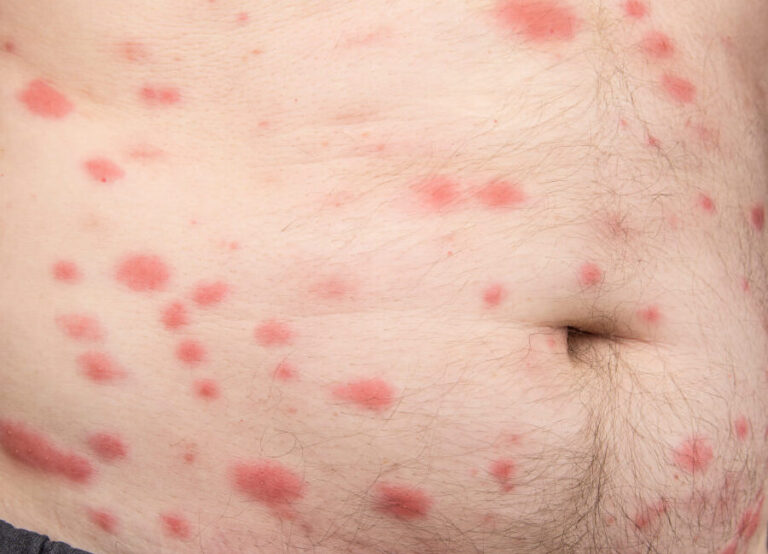 punaises de lit vs eruption cutanee de poison ivy comparaison des morsures et des symptomes