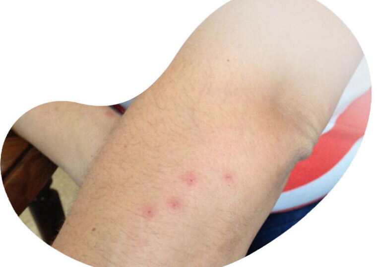 punaises de lit vs moustiques differences entre pieces et morsures
